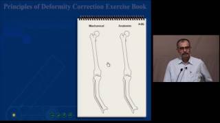 Tibial Uniapical Deformity [upl. by Krum244]