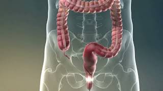 Colonoscopy Procedure in which a doctor uses a colonoscope to examine the large intestine [upl. by Amyas843]