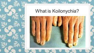 WHAT TO KNOW ABOUT KOILONYCHIA  NAIL DEFORMITIES  CLINICAL MEDICINE  MBBS REVISION GUIDE [upl. by Aremat]