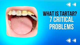 What Is Tartar 7 Critical Problems And Diseases To Prevent [upl. by Rorke]