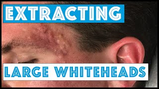 Acne Vulgaris and Extracting large Whiteheads  Part 1 [upl. by Abdella27]