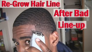 How to ReGrow your Hairline Naturally After Bad line upHaircut [upl. by Oriana]