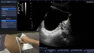 Index de protrusion prostatique en échographie [upl. by Noloc]