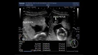 Ultrasound Video showing twin pregnancy with one alive and one dead fetus [upl. by Ecnadnak656]