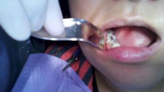 Portland OR Dentist Pain Free Tooth Extraction Video [upl. by Llenehc379]