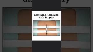 Removing Herniated Disk Surgery ytshorts youtube youtubeshorts shortvideo shots shortvideo [upl. by Buchalter]