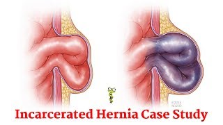 Incarcerated inguinal hernia [upl. by Okika377]