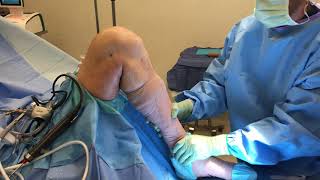 Knee Motion After Arthroscopic Arthrofibrosis Removal [upl. by Shultz302]