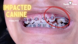 Impacted Canine Braces Treatment  6 Months progress  Video 5  Tooth Time Family Dentistry [upl. by Demona]