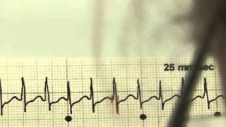 EKG für Pflege Teil 19  Supraventrikuläre Tachykardie interpretieren [upl. by Andaira]