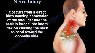 Brachial Plexus Stinger Burner Nerve Injury  Everything You Need To Know  Dr Nabil Ebraheim [upl. by Alathia]