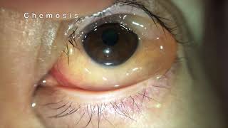 Chemosis of Conjunctiva [upl. by Spurgeon]