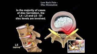 Low Back Pain  Disc Herniation  Everything You Need To Know  Dr Nabil Ebraheim [upl. by Rains50]