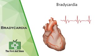 Bradycardia [upl. by Eniamaj]