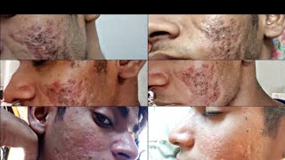 My Isotretinoin Journey 5 month on Accutane [upl. by Eradis758]