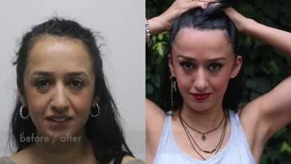 Hairloss in women Hair Transplant women with 1800 Grafts [upl. by Howell]