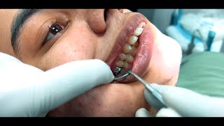 Mastering Orthodontics Treatments for Proclination Class II Malocclusion and Forward Placed Teeth [upl. by Aubry]