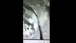 Syndrome de Cockett thrombose veine iliaque gauche thrombolyse et angioplastie avec stent [upl. by Kreg330]