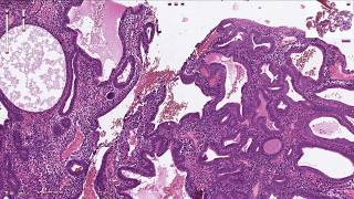 Endometrial Hyperplasia  Histopathology [upl. by Favrot]