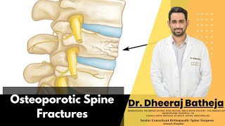 Transform Your Understanding of Osteoporotic Spine Fractures with Dr Dheeraj Batheja [upl. by Allenad718]