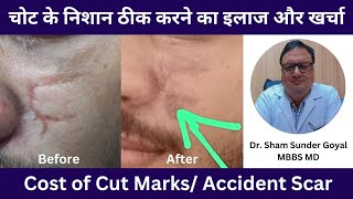 चोट के निशान ठीक करने का इलाज और खर्चा  Cost of Cut MarksAccident Scar [upl. by Ahsoet]