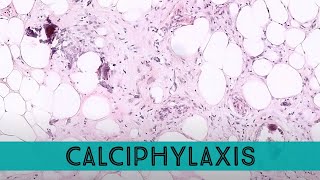 Calciphylaxis under the microscope complication of ESRD chronic kidney disease pathology dermpath [upl. by Euqinu]