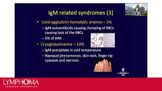 Waldenstrom Macroglobulinemia [upl. by Rovelli]