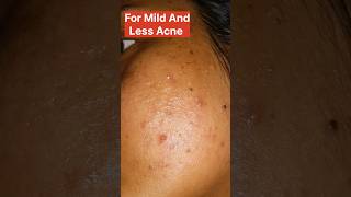 how to treat acne pimples azelaic acid or glocin gel which is better acnetreatment azelaicacid [upl. by Toth]