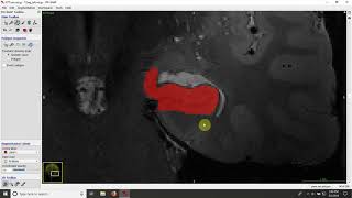 Demonstration of the segmentation of the whole hippocampus and dentate gyrus on T2weighted MRI [upl. by Esil718]