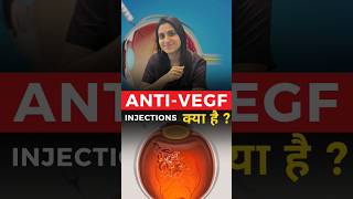 Anti  VEGF Injections क्या है [upl. by Lefton]