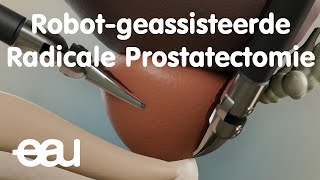 Robotgeassisteerde Radicale Prostatectomie [upl. by Sucramad]