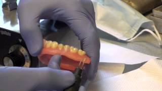 Denture Soft Reline Part 2 [upl. by Fredericka]