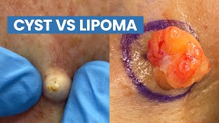 Cyst vs Lipoma Short Pops Compilation  CONTOUR DERMATOLOGY [upl. by Wendeline]