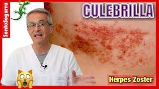 CULEBRILLA 👉 ¿Por qué Hay AHORA más CASOS ✴️ HERPES ZOSTER [upl. by Felise325]