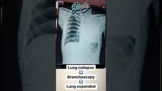 Lung collapse resolved after successful bronchoscopy [upl. by Denver]