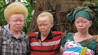 Born Too White What Its Like To Have Albinism in Africa  BORN DIFFERENT [upl. by Karlin369]