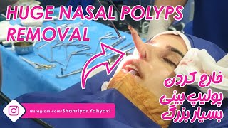 Huge Nasal Polyps Removal By Dr Shahriyar Yahyavi [upl. by Selwyn]