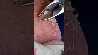 Skincare  Blackheads Removal 169 skincare skincare blackheads blackheads [upl. by Eetnahs]