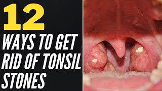 12 Ways To Get Rid Of Tonsil Stones At Home [upl. by Hsotnas]