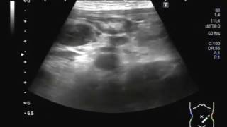 Ultrasound Video showing Mesenteric lymphadenitisLymphadenopathy or adenopathy [upl. by Amuwkuhc106]