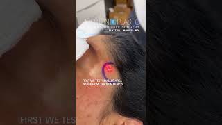 Laser treatment for hyperpigmentation oddlysatisfying hyperpigmentation [upl. by Sivrep511]