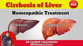 Liver Cirrhosis Homeopathic Treatment [upl. by Aicilav]