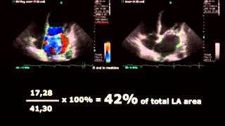 Volodymyr Pavliuk MD PhD Echocardiographic Assesment of Mitral Regurgitation [upl. by Notsej473]