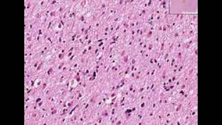 Histopathology BrainAstrocytoma [upl. by Kryska]