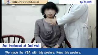 Torticollis Cervical Dystonia [upl. by Garate]