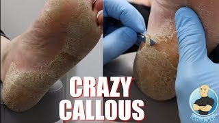 HUGE PAINFUL CALLOUS REMOVAL AND HOW TO STOP IT FROM GROWING [upl. by Aleakcim]