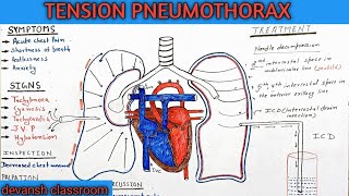 tension pneumothorax in Hindi [upl. by Alhan]