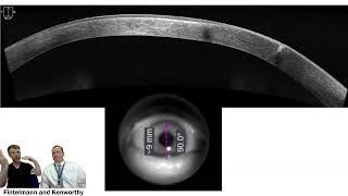 Revision of Gaping Astigmatic Keratotomy [upl. by Elladine]