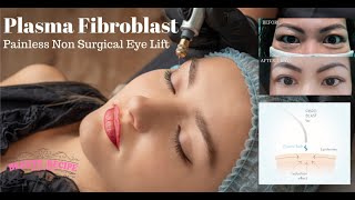 Plasma Fibroblast Non Surgical Blepharoplasty Eyelift Treatment amp Training Singapore [upl. by Shue]