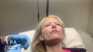 Lip enhancement using Juvederm Smile [upl. by Harol]